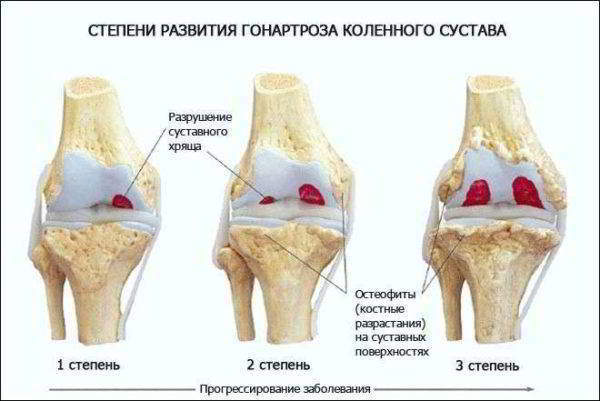 Этапы развития гонартроза колена