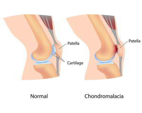 Признаки хондроматоза колена