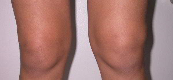 Артропатия коленного сустава