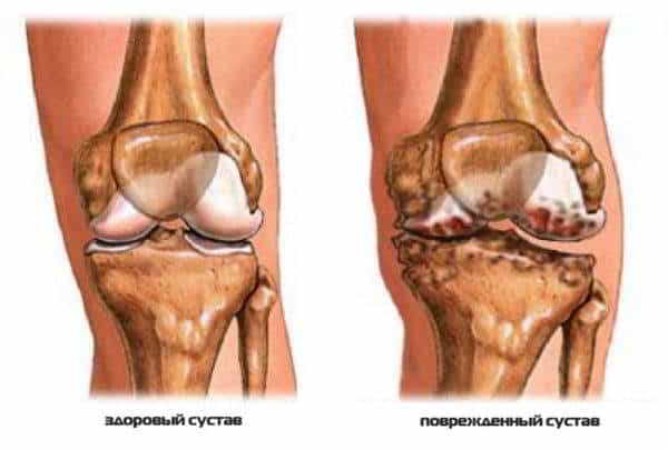 Артропатия коленного сустава