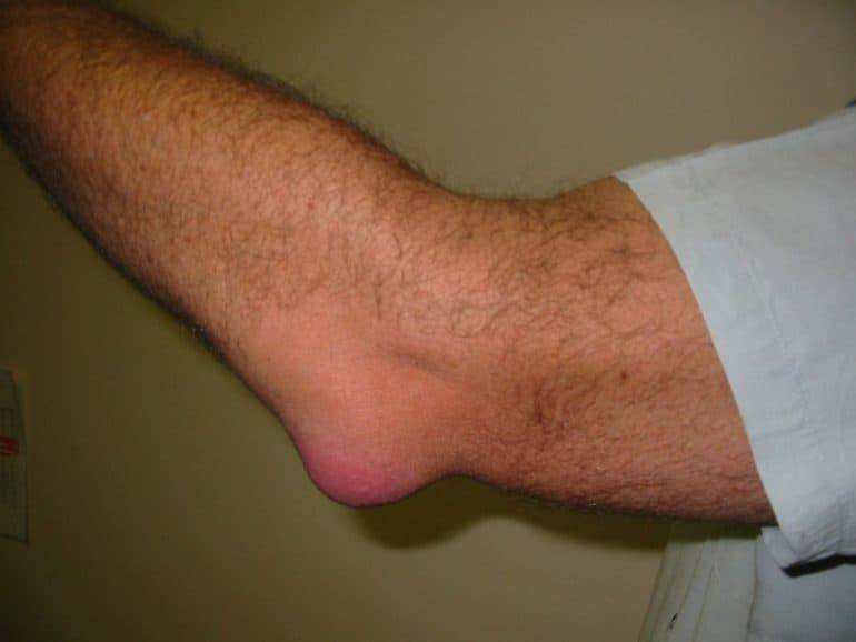 Локтевой бурсит или бурсит локтевого сустава: cимптомы и лечение