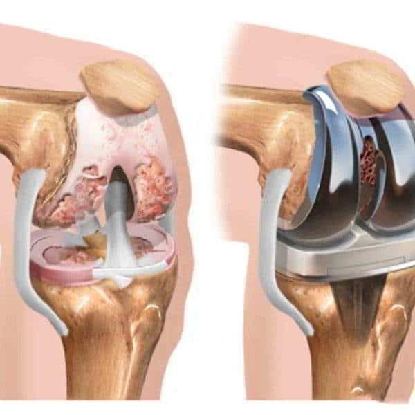 эндопротезирование колена