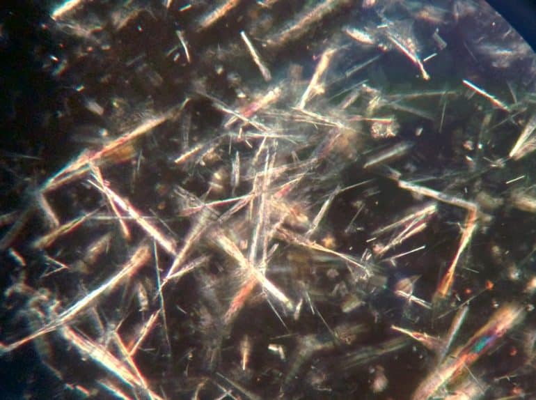 Кристаллы мочевой кислоты в синовиальной жидкости (флуоресцентная микроскопия)