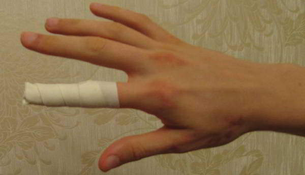 компресс для больного сустава пальца
