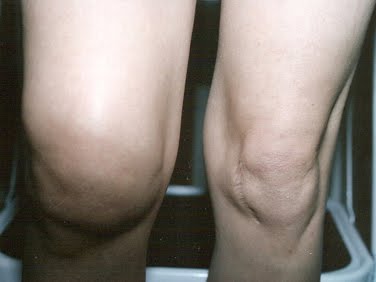 Объем жидкости в коленном суставе – прогностический фактор при артрозе