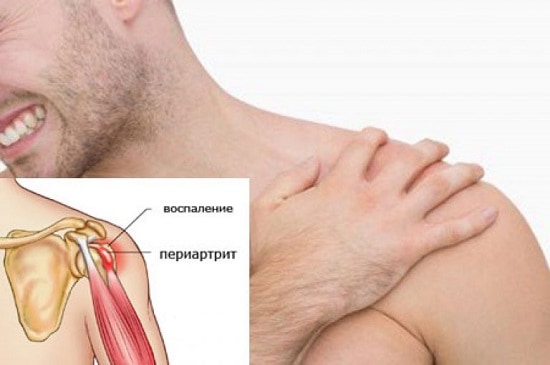 Периартроз плечевого сустава 
