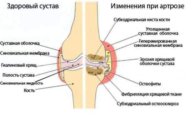 Посттравматический артроз лучезапястного сустава