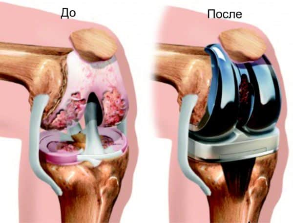 протезирование коленного сустава