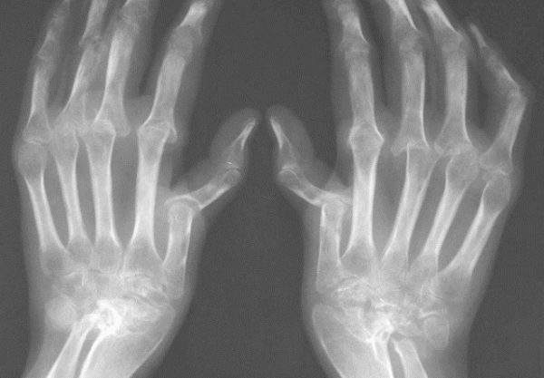 рентген при артрите