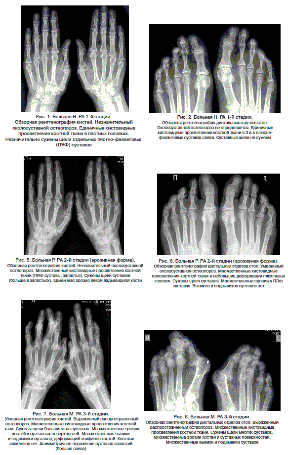 Рентгенологические стадии артроза