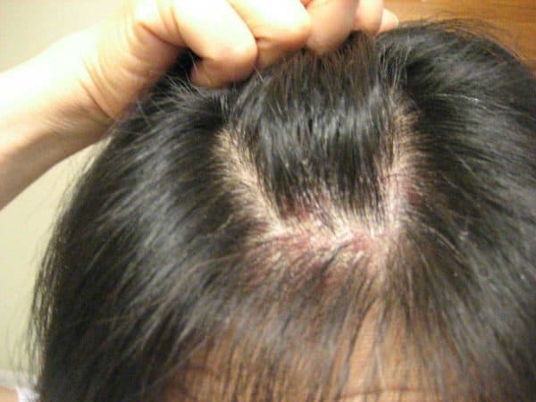 выпадают ли волосы при псориатрическом артрите