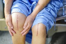 Три причины отложить эндопротезирование коленного сустава