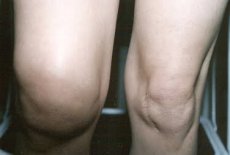 Объем жидкости в коленном суставе – прогностический фактор