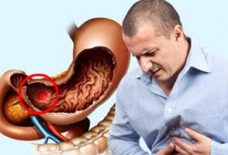 НПВС и желудочно-кишечный тракт: осложнения и их профилактика