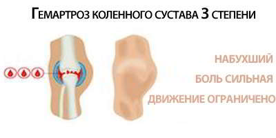 Изображение - Гемартроз коленного сустава после 3-stepen-gemartroza-kolennogo-sustava