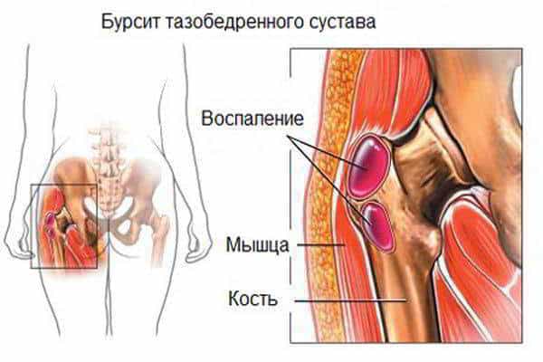 Изображение - Жидкость в тазобедренном суставе лечение Diagnostika-bursitov-tazobedrennoj-oblasti-600x400