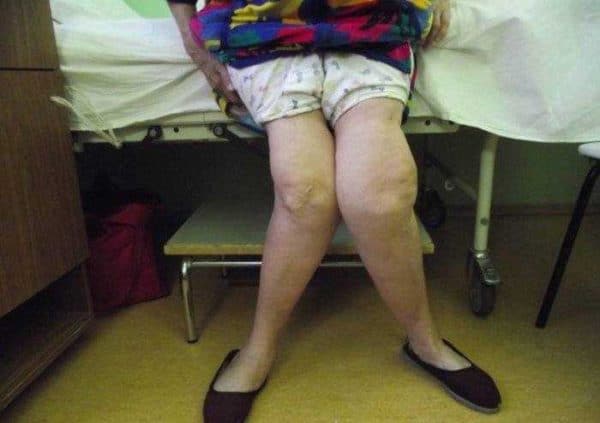 Изображение - Ревматический артрит коленного сустава artrit-7-600x423