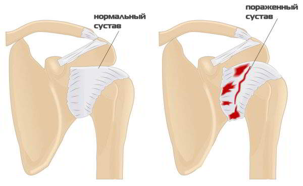 Артропатия плечевого сустава