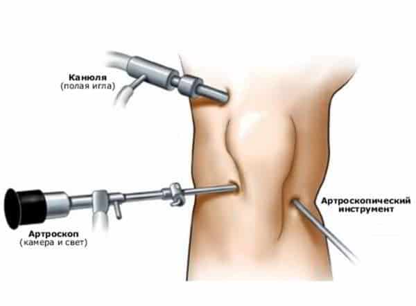 Изображение - Лигаментит коленного сустава лечение artroskopiya-meniska-kolennogo-sustava-600x442