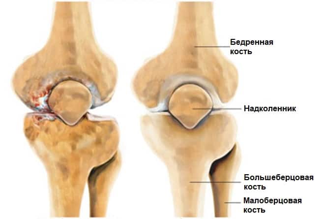 Изображение - Мазь или гель для суставов что лучше artroz-kolennogo-sustava-3