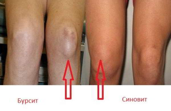 Изображение - Признаки супрапателлярного бурсита коленного сустава bursit-kolennogo-sustava-600x391