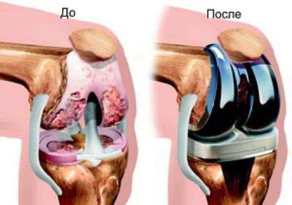 эндопротезирование колена