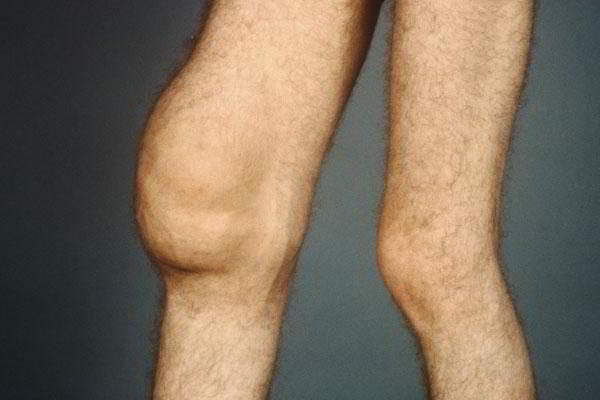 Изображение - Гемартроз коленного сустава после gemartroz-kolennogo-sustava-2-600x400