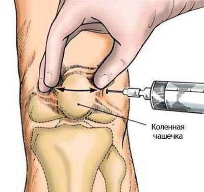 Изображение - Блокирующие уколы в сустав при артрите inekcii-v-sustav
