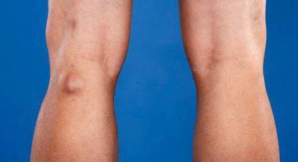 Изображение - Инфрапателлярный бурсит коленного сустава лечение медикаментозное kista-bekkera-oslozhneniya-600x326