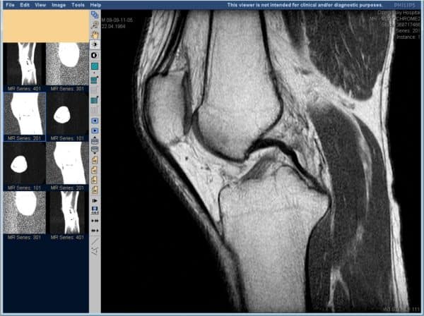 Изображение - Лигаментит коленного сустава лечение mrt-kolena-600x448