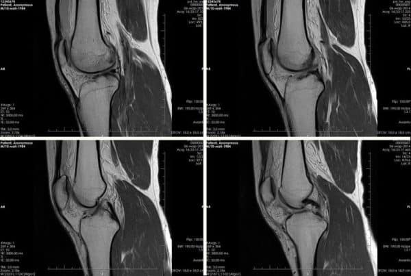 МРТ снимок коленного сустава