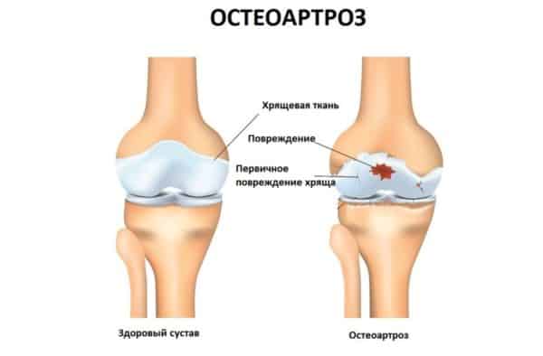 Изображение - Какие структуры сустава поражаются при остеоартрите osteoartrit1-600x394