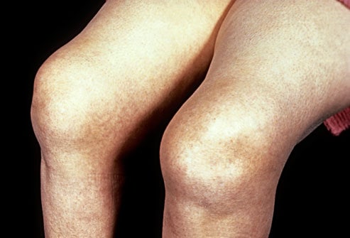 Изображение - Ревматический артрит коленного сустава phototake_rm_photo_of_knees_with_rheumatoid_arthritis