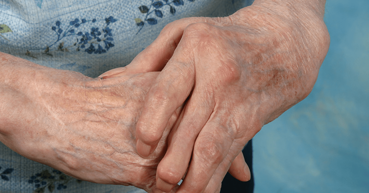 Artrosis o artritis en las manos