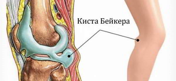 Изображение - Инфрапателлярный бурсит коленного сустава лечение медикаментозное podkolennyy-bursit-1-600x277