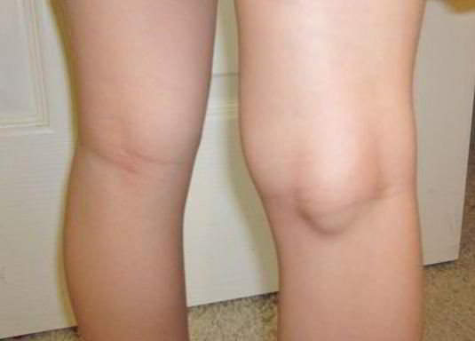 Изображение - Инфрапателлярный бурсит коленного сустава лечение медикаментозное podkolennyy-bursit-2