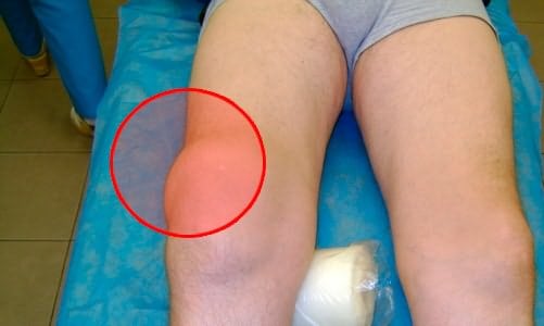 Изображение - Деформирующий гонартроз коленного сустава 3 степени pokrasnenie-v-kolene