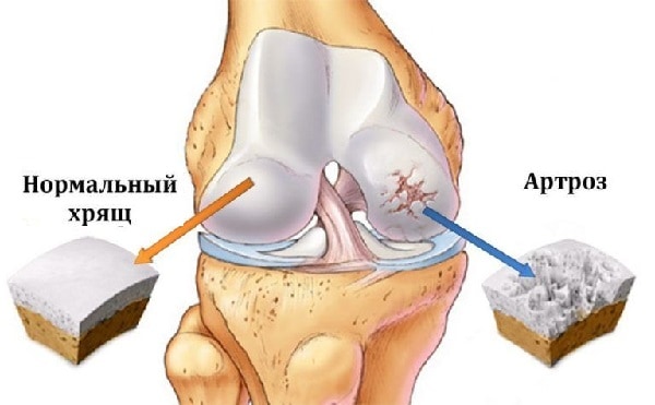 Изображение - Внутрисуставное введение гиалуроновой кислоты в коленный сустав povrezhdenie-hryascha-sustava-pri-artroze