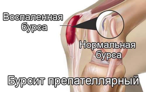 Изображение - Ретропателлярный бурсит колен сустава prepatellyarnyy-bursit-kolennogo-sustava