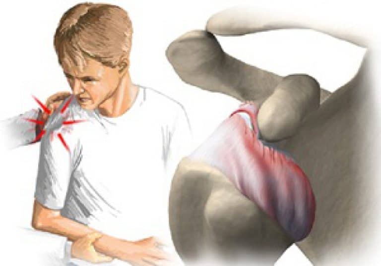 Растяжение связок плечевого сустава: как лечить