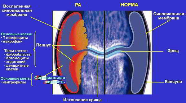 Изображение - Полиартроз плечевого сустава симптомы и лечение revmatoidnyj-artrit