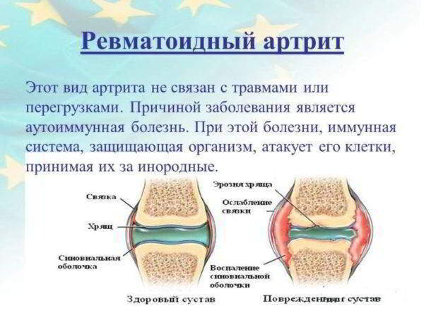 Изображение - Гормональное лечение суставов revmatoidnyy_vaskulit_1-600x450