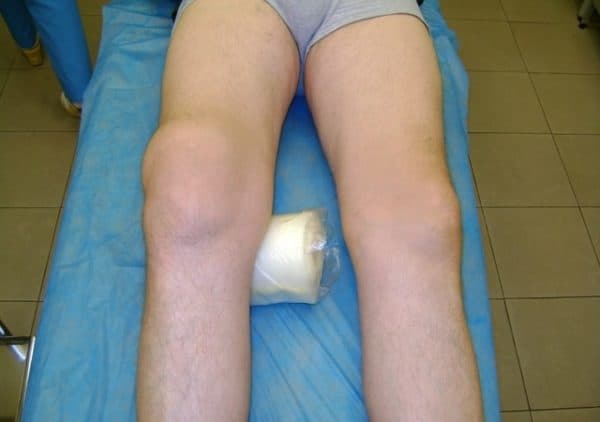 Изображение - Жидкость в мениске коленного сустава zhidkost-v-kolennom-sustave-u-rebenka-600x422